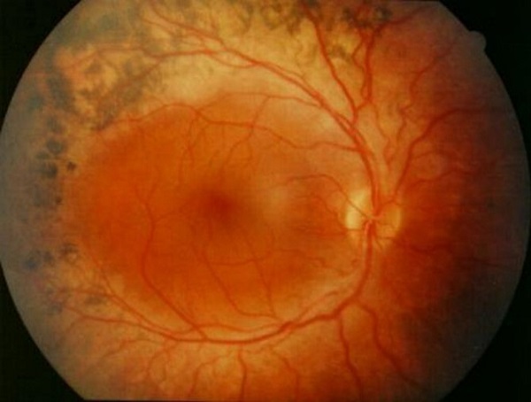 Так выглядит пигментный ретинит